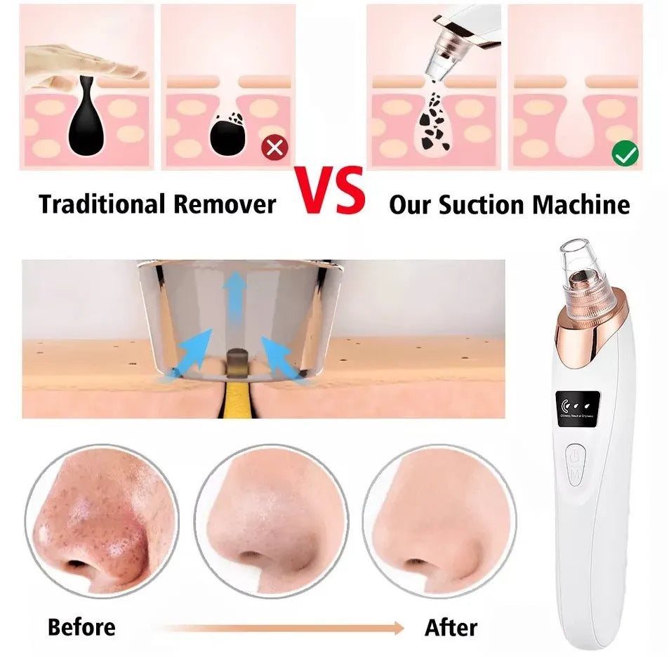5-in-1 Rechargeable Blackhead Remover Machine – Facial Pore Vacuum, Acne Extractor & Deep Cleansing Face Suction Device