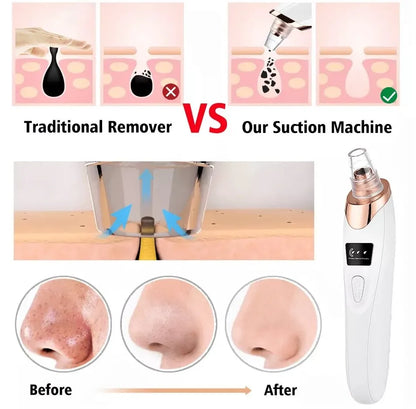 5-in-1 Rechargeable Blackhead Remover Machine – Facial Pore Vacuum, Acne Extractor & Deep Cleansing Face Suction Device